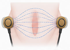 Electrical conductance changes between electrodes as vocal folds make and break contact