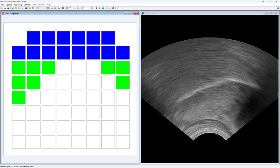 icSpeech Professional Edition — simultaneous EPG palatograph and ultrasound tongue imaging showing tongue–palate contact pattern for /l/ with regional colour coding