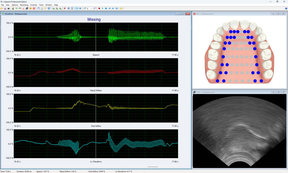 icSpeech Professional Edition — multiparameter display showing EPG palatograph, ultrasound tongue imaging, speech waveform, nasal airflow, oral airflow and Lx waveform recorded simultaneously