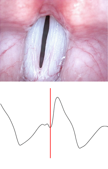 Lx waveform during closing phase — waveform rises as vocal folds move into contact