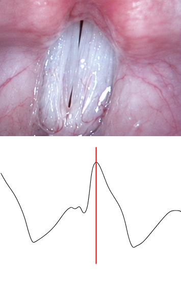 Lx waveform at maximum contact — waveform peaks as conductance reaches its highest point
