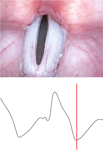 Lx waveform during open phase — waveform sits at trough as vocal folds are apart