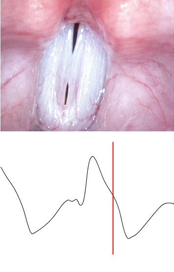 Lx waveform during opening phase — waveform falls as vocal folds begin to separate