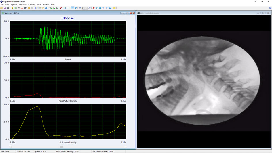 Videofluoroscopic image of the velopharyngeal mechanism combined with speech, nasal and oral airflow waveforms