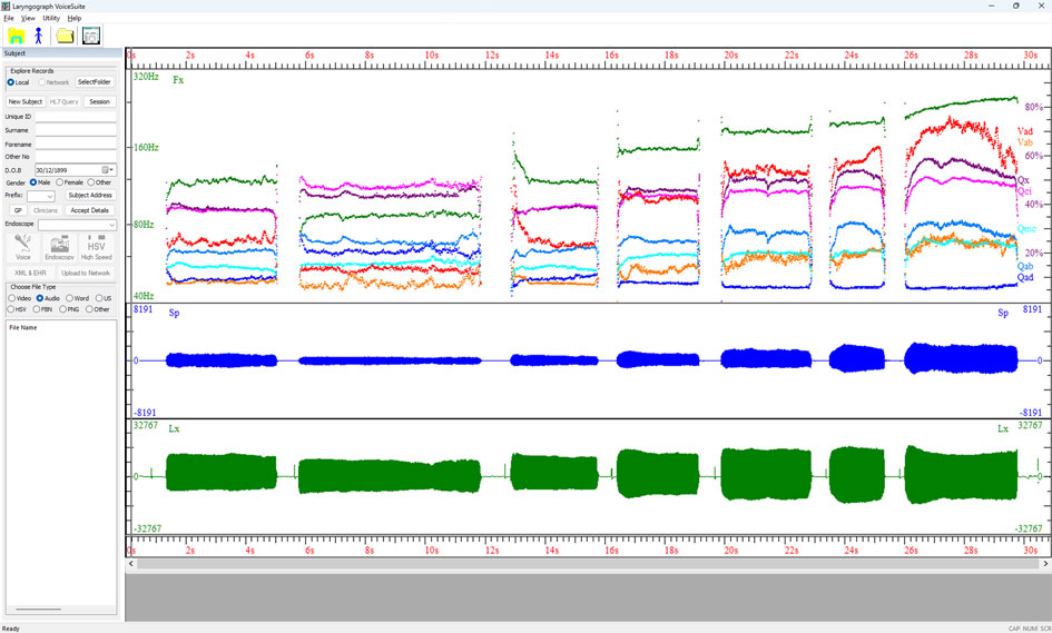 VoiceSuite FxQx display showing fundamental frequency (Fx), contact quotient (Qx) and related vocal fold parameters across a series of sustained vowel productions at varying pitch and effort, with simultaneous speech (Sp) and Lx waveform recordings