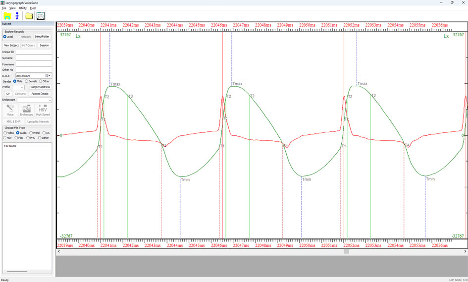 VoiceSuite Lx waveform (green) and its derivative DLx (red) showing three complete vocal fold vibratory cycles with time markers indicating maximum contact (Tmax), minimum contact (Tmin) and contact phase boundaries (T2, T3, T4) — modal vowel produced by an adult male
