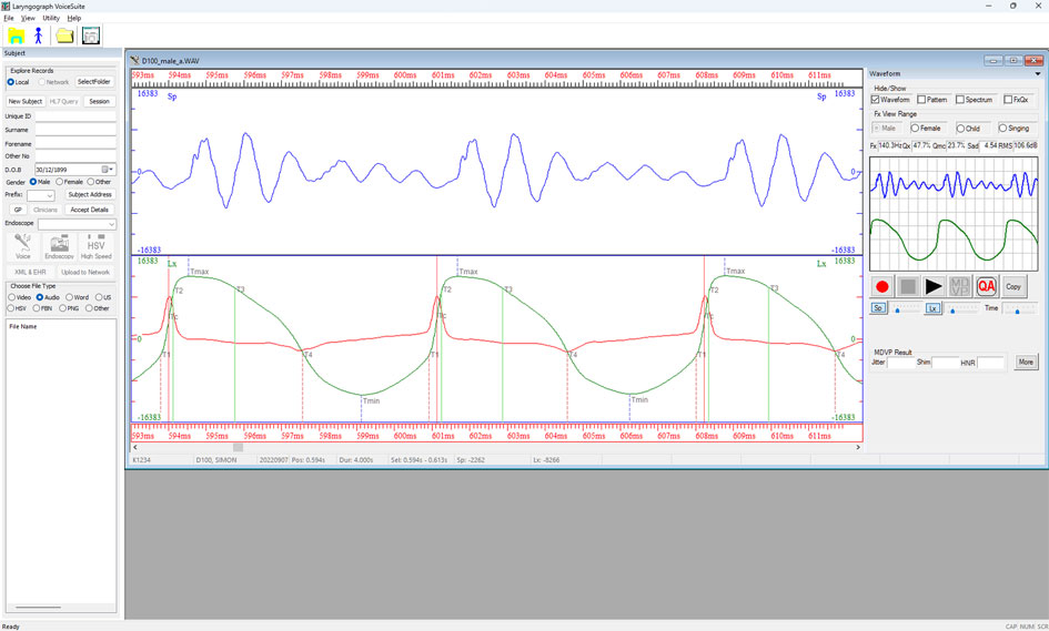VoiceSuite EGG analysis showing the Lx waveform (green) and its derivative DLx (red) with cycle time markers indicating vocal fold contact and opening instants, alongside simultaneous speech waveform — illustrating cycle-by-cycle parameter derivation from the Lx signal