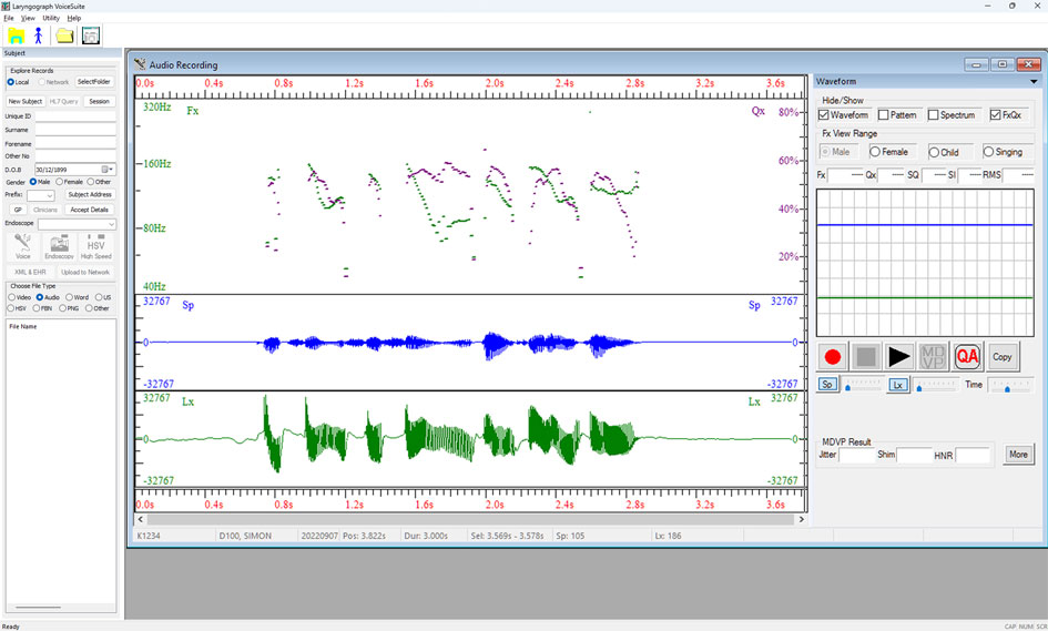 VoiceSuite real-time recording interface showing fundamental frequency (Fx) and contact quotient (Qx) traces captured live during connected speech, with simultaneous speech (Sp) and Lx waveform display
